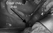 Thường xuyên bỏ bữa, thức khuya, chàng trai bị xuất huyết tiêu hóa, phải cắt dạ dày