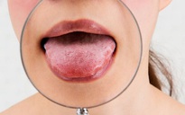 4 dấu hiệu thiếu vitamin D làm xuất hiện bất thường trên lưỡi