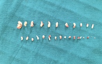 Phát hiện 28 chiếc răng trong khối u bệnh nhi 9 tuổi