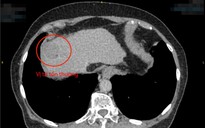 Cụ bà đi khám sức khỏe, bác sĩ phát hiện khối u gan 3 cm