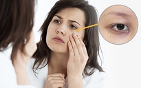 Làm sao để cải thiện thâm quầng mắt cho đôi mắt tươi trẻ va tinh anh?