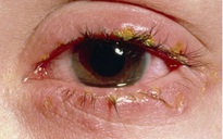TP.HCM: Nhiều người bị đau mắt đỏ, nhức mắt, đổ ghèn