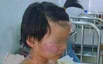 Tình hình sức khỏe 4 bệnh nhi bị bỏng nặng trong vụ cháy nhà ở Tây Ninh