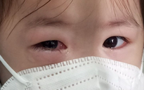 Đã xác định được 2 tác nhân gây bệnh đau mắt đỏ trên địa bàn TP.HCM