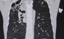 Người đàn ông ho ra cả chén máu vì vỡ mạch máu phế quản