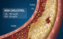 Điều gì xảy ra nếu mức cholesterol cao?