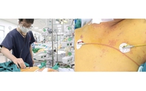 Suy gan, suy thận do nhiễm xoắn khuẩn vàng da sau lũ lụt