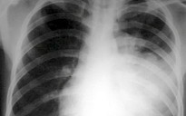 Cảnh báo về vi khuẩn trong hơi thở dễ làm lây lan bệnh hô hấp