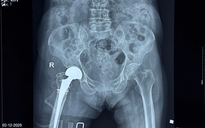 Thay khớp háng thành công cho cụ bà 100 tuổi