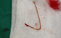 Người phụ nữ bị sỏi túi mật và áp xe gan do nhiễm giun sán