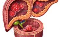 Thực phẩm bẩn và nguy cơ ung thư