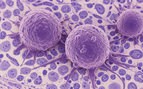 Xét nghiệm máu phát hiện ung thư 3 năm trước khi phát bệnh