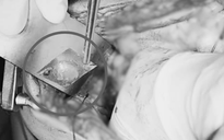 Đau bụng dữ dội, nhập viện phát hiện bị thủng ruột do nuốt viên thuốc còn nguyên vỏ