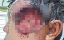 Dùng thuốc diệt cỏ vệ sinh vết thương, nam bệnh nhân hoại tử mặt, nhiễm dòi