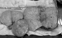 3 khối bướu mỡ nặng 1,5 kg được lấy ra khỏi cơ thể người phụ nữ