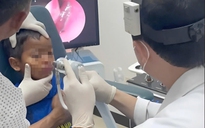 Gắp ra con đỉa sống ký sinh trong mũi bệnh nhi