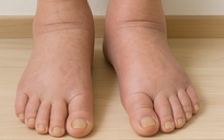 Ngày mới với tin tức sức khỏe: Biểu hiện của từng giai đoạn suy thận