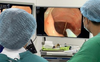 Đau bụng 1 năm mới phát hiện 3 xương cắm sâu trong đại tràng
