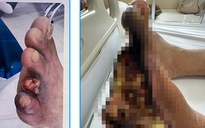 Bị hoại tử bàn chân do chủ quan với vết loét nhỏ ngoài da