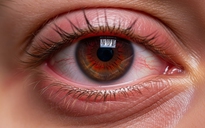 3 biểu hiện ở mắt cảnh báo vấn đề về thận