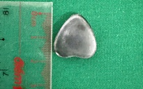 Trong lúc chơi đùa, bé trai 6 tuổi nuốt nam châm hình trái tim