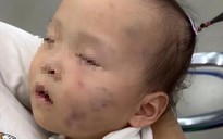 Tạm giữ bảo mẫu vụ bé gái 15 tháng tuổi có nhiều vết bầm tím