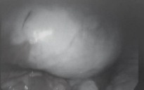 Đau bụng âm ỉ, nhập viện bác sĩ phát hiện khối u buồng trứng lớn