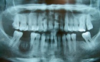 Thạch tín diệt tủy răng trong nha khoa gây hoại tử xương, mô, quá nhiều độc tính