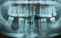 Sử dụng thạch tín trong điều trị nội nha gây nguy cơ gì?