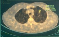 Bệnh viện Bạch Mai phát triển AI hỗ trợ chẩn đoán chính xác ung thư phổi