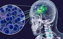 Cà Mau ghi nhận 3 ca nghi viêm não mô cầu, 1 trường hợp tử vong