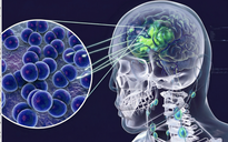 Cà Mau: 3 ca nghi viêm não mô cầu, 2 ca dương tính, 1 ca tử vong