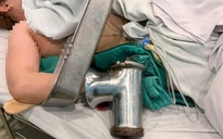TP.HCM: Người phụ nữ đi cấp cứu với bàn tay phải dính chặt trong máy xay thịt