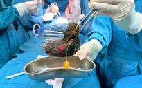 Búi tóc 'lấp kín' dạ dày bé gái 7 tuổi, cảnh báo hội chứng nguy hiểm