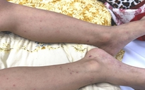 TP.HCM: Cứu sống bé trai 7 tuổi mắc não mô cầu