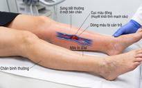 5 dấu hiệu cục máu đông ở chân có thể gây thuyên tắc phổi