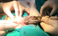 Phẫu thuật lấy búi tóc dài gần 20 cm trong dạ dày bệnh nhi mắc hội chứng Pica