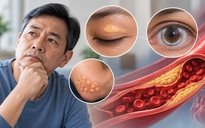 5 dấu hiệu trên da, mắt có thể liên quan cholesterol cao