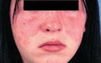 Lupus ban đỏ hệ thống