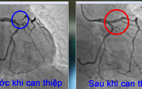 Cứu người đàn ông bị suy tim nặng sau nhồi máu cơ tim