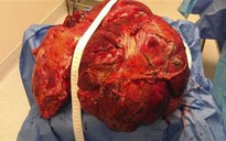 Phẫu thuật lấy khối u buồng trứng nặng đến 40 kg