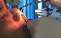 Con đỉa dài 6 cm sống trong mũi một bệnh nhân