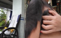 Điều trị miễn phí cho bé gái bị bệnh mọc nhiều lông