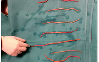 Bác sĩ cũng sốc khi lấy 14 con giun đũa ra khỏi ống mật một phụ nữ