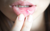 11 cách trị loét miệng tại nhà hiệu quả bạn cần biết