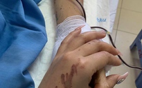 Bạn gái của Việt kiều Canada bị tạt axít: ‘Không ai đáng phải chịu bi kịch này’