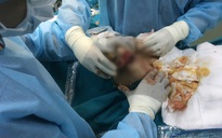 Nữ Việt kiều suýt hỏng ngực sau 3 năm tiêm silicon
