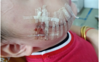 Tai nạn thương tâm tại nhà: Trẻ bị que sắt cắm vào đầu, bị chó cắn vào mặt