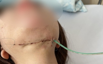 Cô gái bị hoại tử ở cổ dài 15 cm sau tiêm chất tan mỡ nọng cằm tại spa