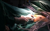 Việt Nam thực hiện phẫu thuật nội soi tuyến giáp 1 lỗ đầu tiên trên thế giới